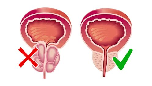 Próstata antes e despois de usar Prostalina