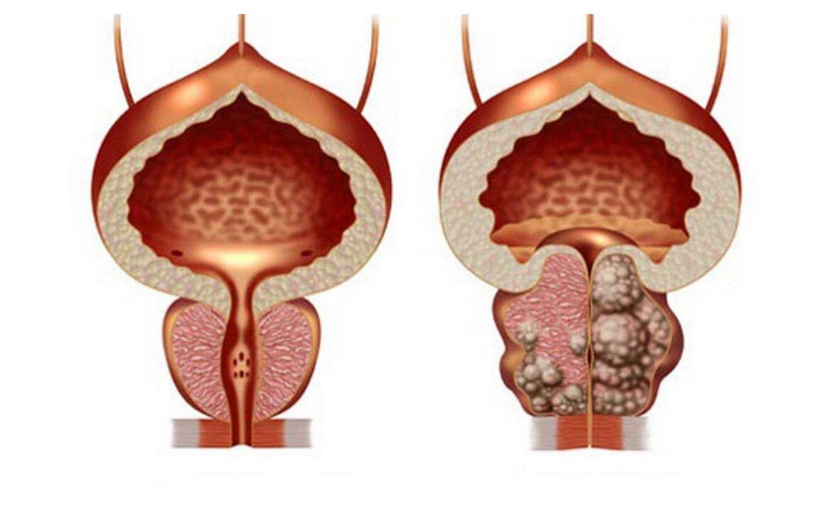 Adenoma de próstata